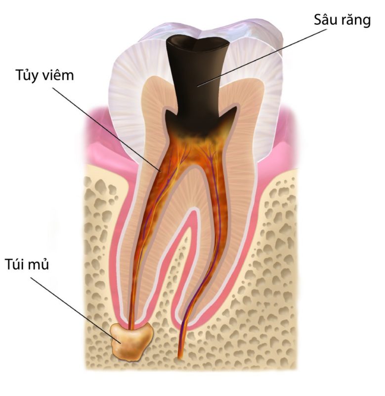 Chữa tủy răng trong bao lâu?