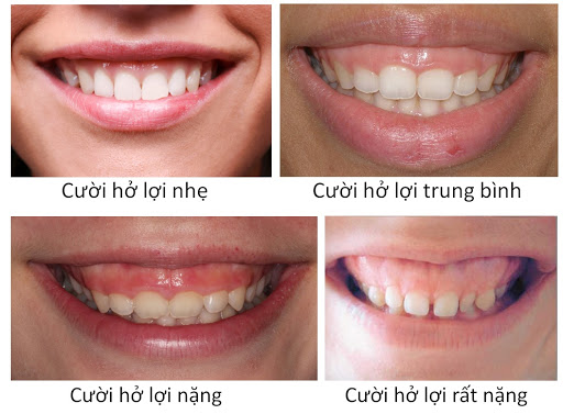 NGUYÊN NHÂN GÂY NÊN CƯỜI HỞ LỢI