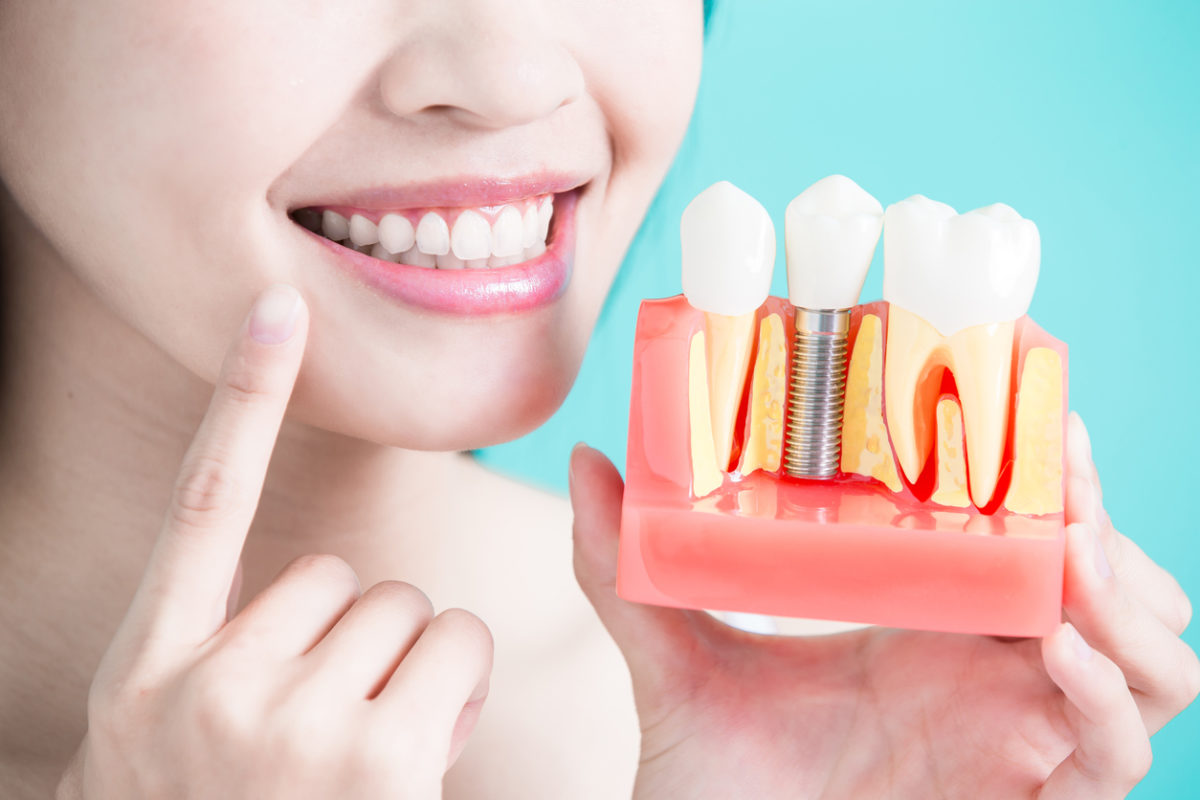 Ghép xương trong cấy ghép implant