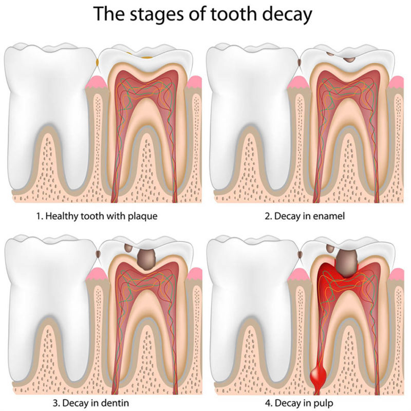 GIẬT MÌNH TRƯỚC TÁC HẠI CỦA VIÊM CHÂN RĂNG