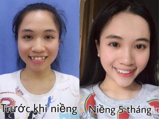Những câu hỏi về chỉnh nha- niềng răng