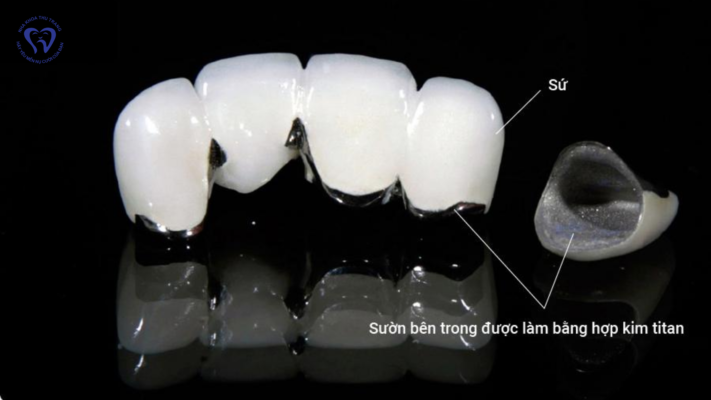Chọn màu răng sứ thế nào