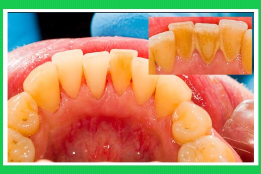 Tiêu xương răng bệnh lý nguy hiểm