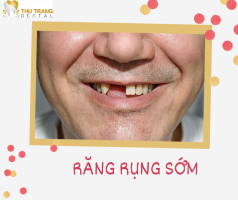 Hậu quả khi rụng răng sớm