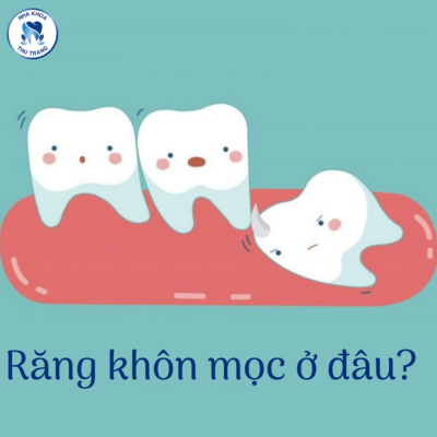 Răng khôn mọc lệch ra má