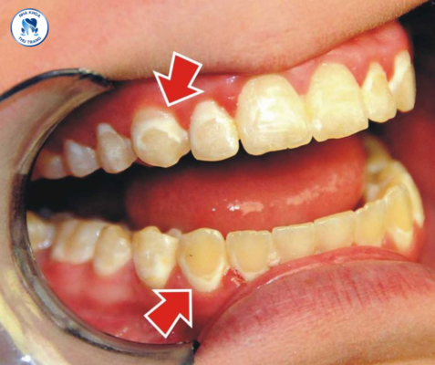 thiểu sản men răng là gì?
