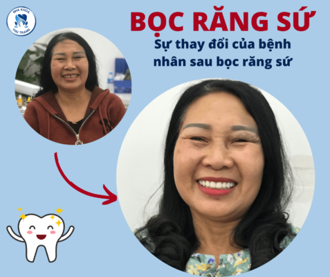 Sự thay đổi của khách hàng tại Thu Trang sau khi bọc răng sứ