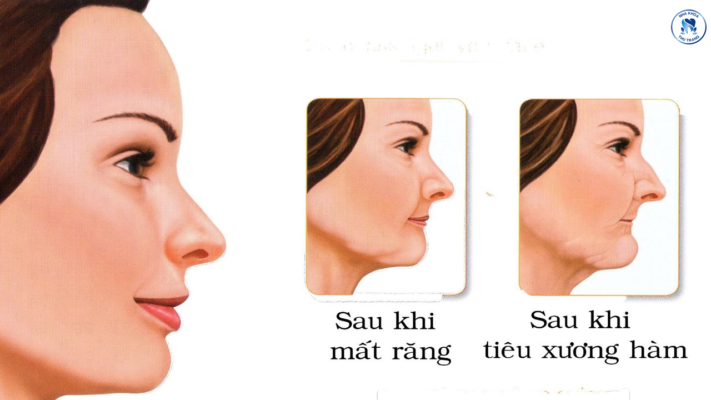 Tiêu xương răng bệnh lý nguy hiểm