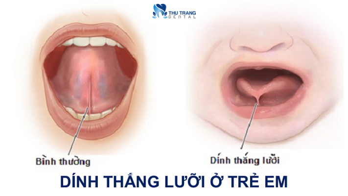 Dính thắng lưỡi ở trẻ em