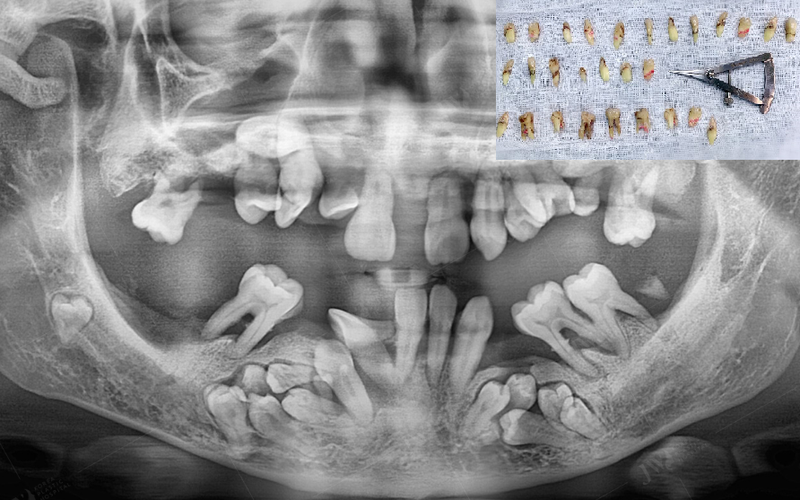 Răng mọc trong xoang - Bệnh lý răng miệng thường bị bỏ qua
