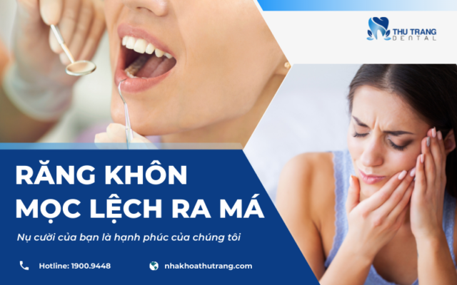 Răng khôn mọc lệch ra má