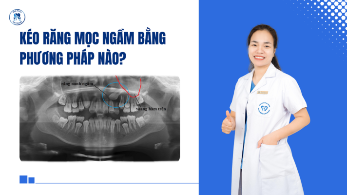 Kéo răng mọc ngầm bằng phương pháp nào?