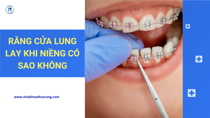 Răng cửa lung lay khi niềng có sao không?