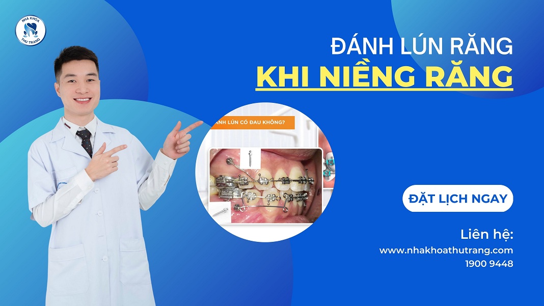Đánh lún răng khi niềng là gì?