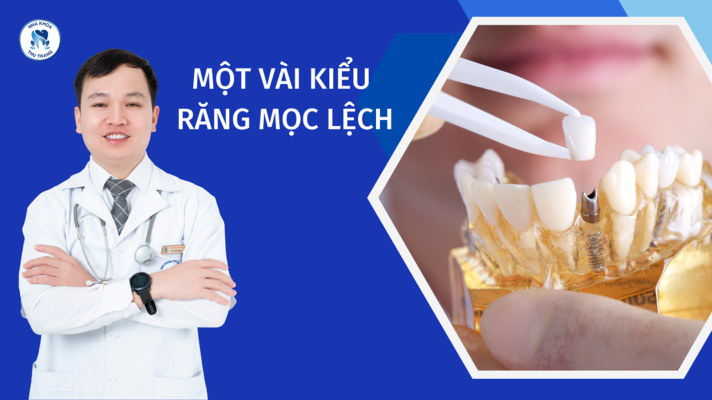 Một vài kiểu răng mọc lệch